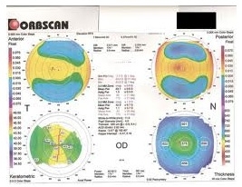 Mapa de um exame de tomografia de cornea